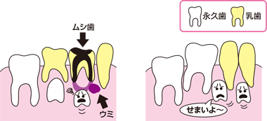 乳歯虫歯
